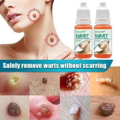 Wart Remover Serum, Fast Acting Skin Tag Remover For All Skin Types, Armpit Wart Remover Serum Treatment - Remove Skin Tags & Corns, Skin-Tag-Removal, Fast-Acting Skin Wart Removal, Skin Tag Remover Liquid, Safe Skin Tag Remover - 1PCS
