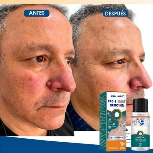 Skin Tag & WART Remover Armpit Wart Remover Treatment - Remove Skin Tags & Corns