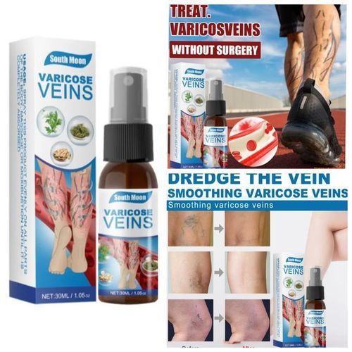 Varicose Veins Spray Removal Treatments
