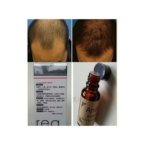 Andrea Fastest HairBald Growing Oil Cream- 20ml