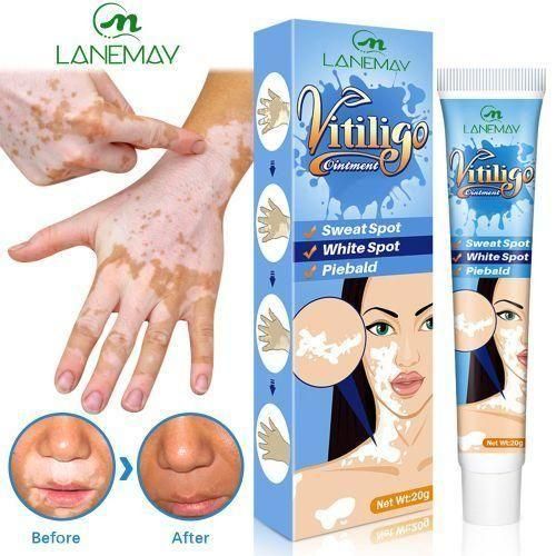 Herbal Extract Vitiligo Removal Onitiment Treatments