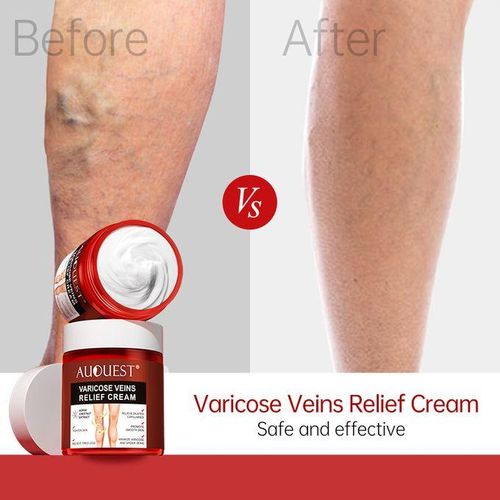 Varicose Veins Relief Cream