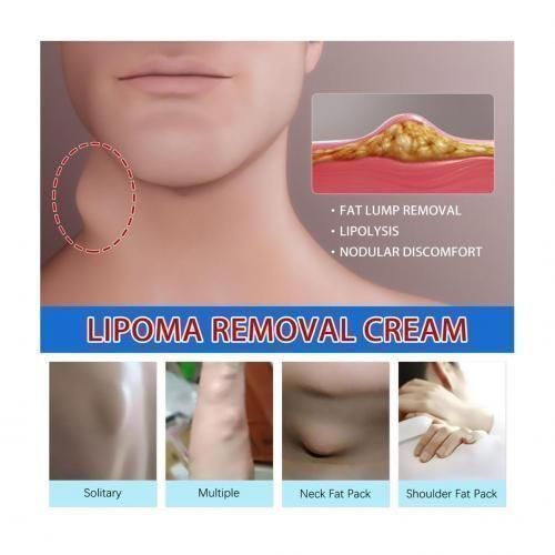 Lipoma Removal Cream X 2 Packs
