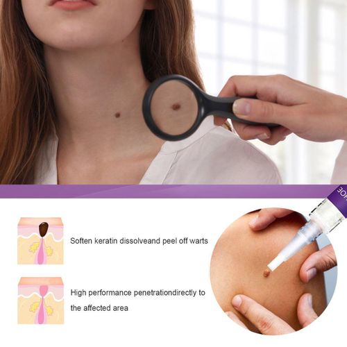 100% Pure Natural SKIN TAGS and Wart Remover Liquid – 12% Wart Liquid – Fast Acting Wart Freezing, for Warts, Plantar Warts Wart Remover Serum Oil for Fast Painless Wart Removing Gel Skin Precision Applicator - Wart Corns Warts Callus Genital Wart