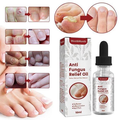 Ant-Fungus Ingrown Toenail Nail Drops Treatment, Ingrowth Toenail Correction Treatment Oil, Nail Helper Ingrowth Toenail Correction Treatment Oil, Ingrown Toenail Drops, Nail Fungus Treatment, Nail Treatment, Nails Repair Treatment for Fungus,