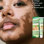 product_image_name-Sumifun-Original Vitiligo cream-4