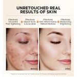 product_image_name-Generic-ACNE CONTROL (FOR CLEAR SKIN) SET-5