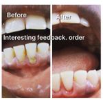 product_image_name-Generic-Teeth Whitener Kit That Removes Stain-2