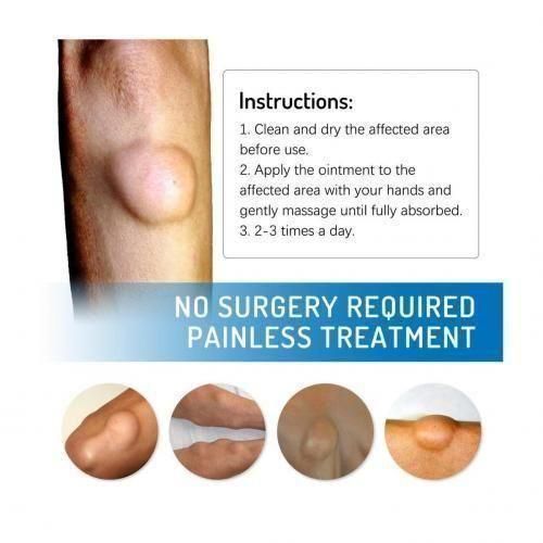 Generic LIPOMA REMOVAL/RELIEF CREAM - image 3