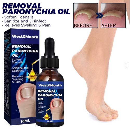 product_image_name-West&Month-Ingrown Toenail Treatment, Toe Nail Softener,Supports Nail Growth, Easy Nail Trimming Formula, Gentle on Nails – Fungal Nail Treatment, Toenail Fungus Treatment, Nail Strengthener for Weak Nails, Ingrowth Toenail Correction Treatment Oil-2