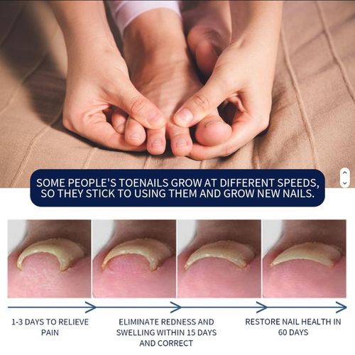 product_image_name-West&Month-Ingrown Toenail Treatment, Toe Nail Softener,Supports Nail Growth, Easy Nail Trimming Formula, Gentle on Nails – Fungal Nail Treatment, Toenail Fungus Treatment, Nail Strengthener for Weak Nails, Ingrowth Toenail Correction Treatment Oil-3