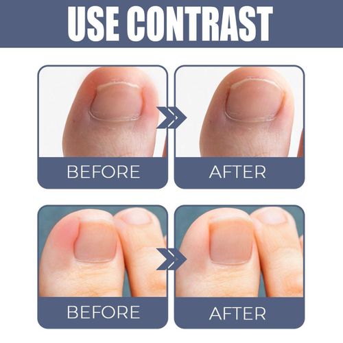 product_image_name-West&Month-Ingrown Toenail Treatment, Toe Nail Softener,Supports Nail Growth, Easy Nail Trimming Formula, Gentle on Nails – Fungal Nail Treatment, Toenail Fungus Treatment, Nail Strengthener for Weak Nails, Ingrowth Toenail Correction Treatment Oil-5