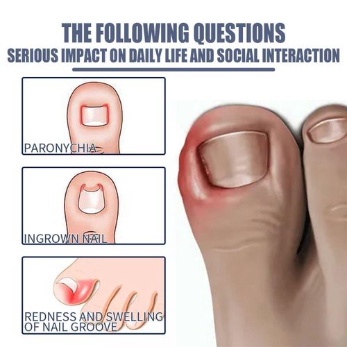 product_image_name-West&Month-Ingrown Toenail Treatment, Toe Nail Softener,Supports Nail Growth, Easy Nail Trimming Formula, Gentle on Nails – Fungal Nail Treatment, Toenail Fungus Treatment, Nail Strengthener for Weak Nails, Ingrowth Toenail Correction Treatment Oil-6