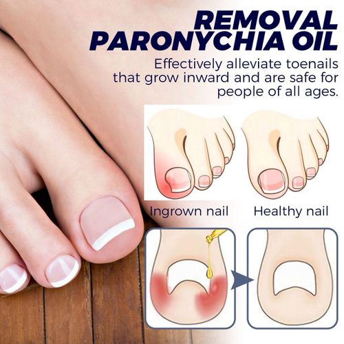 product_image_name-West&Month-Ingrown Toenail Treatment, Toe Nail Softener,Supports Nail Growth, Easy Nail Trimming Formula, Gentle on Nails – Fungal Nail Treatment, Toenail Fungus Treatment, Nail Strengthener for Weak Nails, Ingrowth Toenail Correction Treatment Oil-7