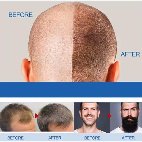 product_image_name-East moon-Minoxidil hair cream hair oil for hair growth for Men and women-1