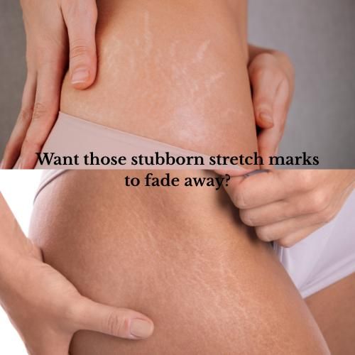 product_image_name-Generic-BEAUTY ROUTINE OFFICIAL DERMAFIX TRETINON CREAM STRETCH MARKS -2