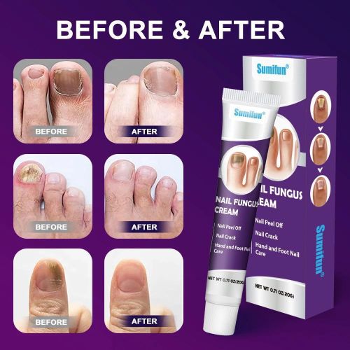 product_image_name-Sumifun-Nail Fungus, Anti-bacterial, Cream For Foot And Fingernails Care-3