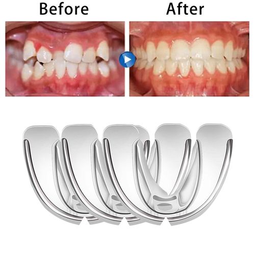 Generic 3in1 Hard And Soft Invisible Braces Smile