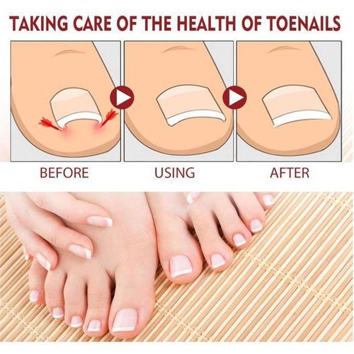 product_image_name-JAYSUING-Advanced Nail Care Anti Fungus Ingrown Toenail Treatment Removal  Anti-Fungal Whitlow Nail Treatment Oil -7days Rapid Nails Solution-4