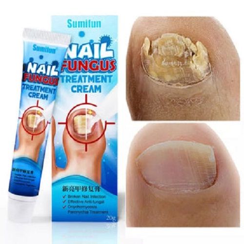 Mightlink 20g Paronychia Cream Natural Ingredients Fast Healing Smoothing  Anti-infective Discolored Damaged Nail Repair Ointment for Toenail -  Walmart.com