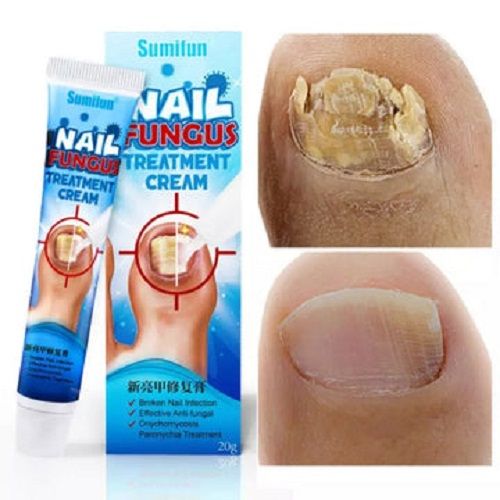 The 8 Best Toenail Fungus Treatments of 2024