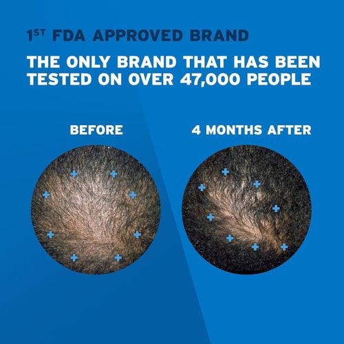 product_image_name-Rogaine-5% Minoxidil Hair Loss and Hair Regrowth, Topical Aerosol treatment-3