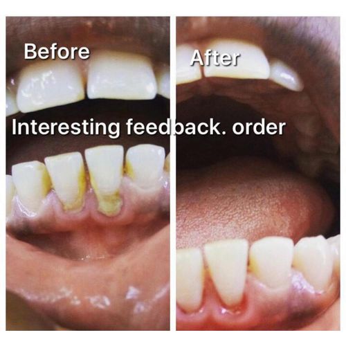 product_image_name-Generic-Teeth Whitener Kit That Removes Stain-2