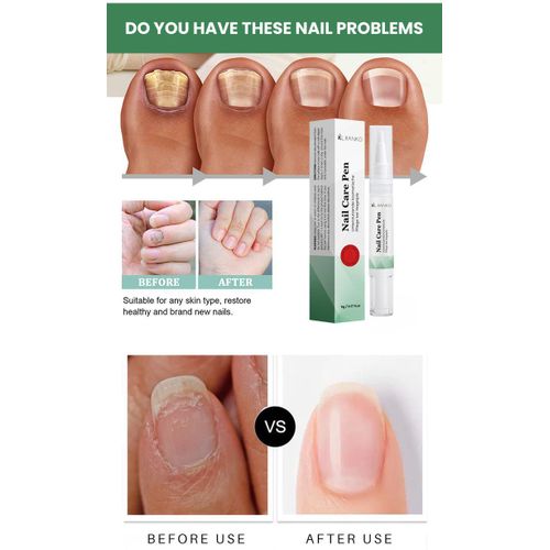 product_image_name-Generic-NAIL CARE PEN  AND FUNGAL NAIL TREATMENT-  2pcs-4