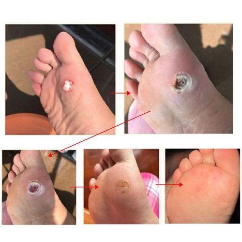 Foot corn plaster store