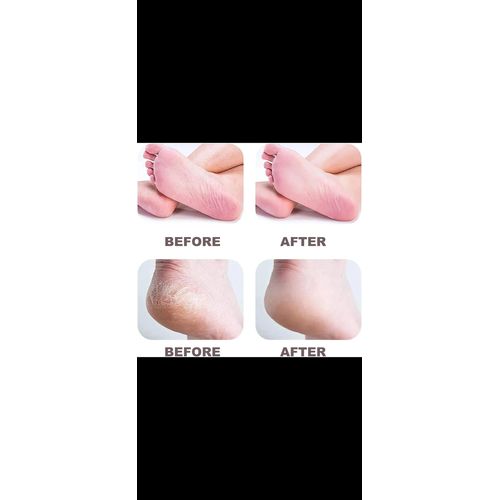 product_image_name-Generic-Rechargeable unisex corn and callus remover -5