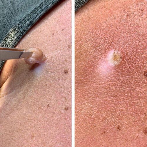 product_image_name-KanyeHB-Wart Remover Ointment,Fast Acting Cream Wart Gel Remover-3