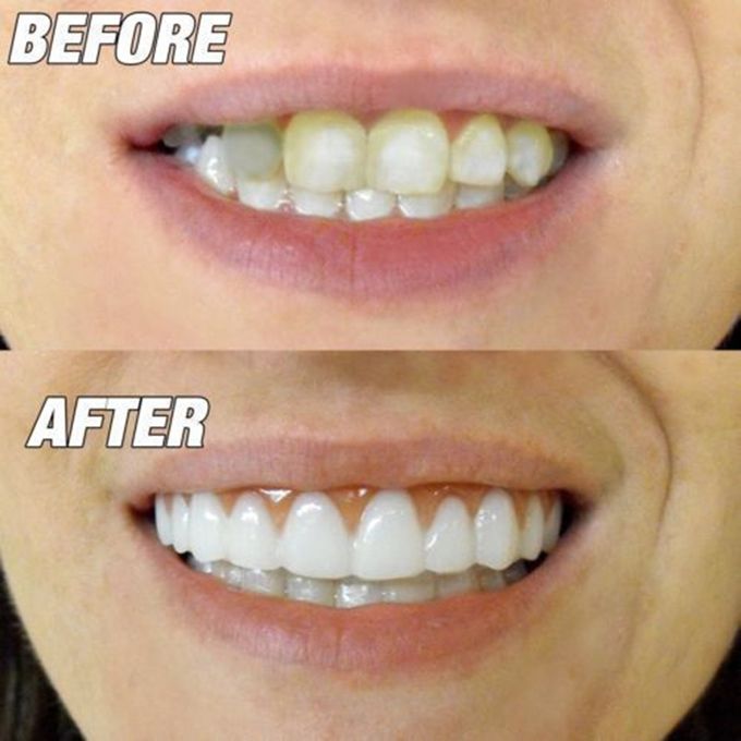 Enhance Your Smile with Silicone Whitening Simulation Braces – Comfortable Fit & Natural Look