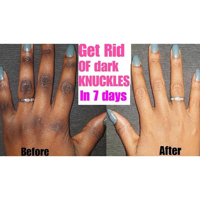 best cream to clear dark knuckles