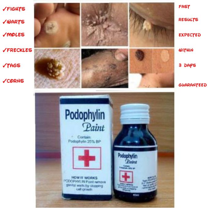 Podowart Podophyllin Fluid Skin Warts/Freckle/Spots/Tags Cream